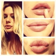 Контурная пластика,  увеличение губ,  увеличение скул,  коррекция,  подтяжка лица